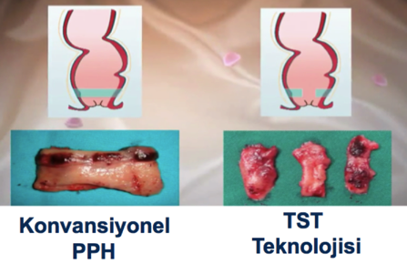 TST 33 PPH Karsilastirma